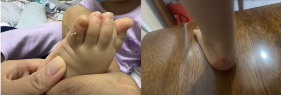 千元童鞋把脚穿肿?泰兰尼斯遭家长“围攻”,医生警惕影响发育,90%专利竟是外观设计